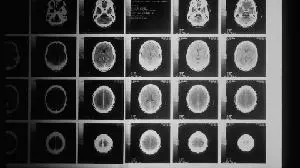BrainChild Bio moves CAR-T into pivotal study for paediatric brain cancer