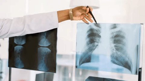 Rein Therapeutics Wins U.K. Approval to Launch Phase 2 Clinical Trial of LTI-03 in Idiopathic Pulmonary Fibrosis