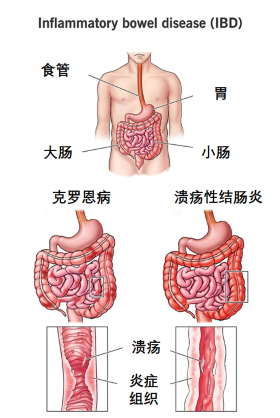 炎症性肠病，制药巨头必争之地