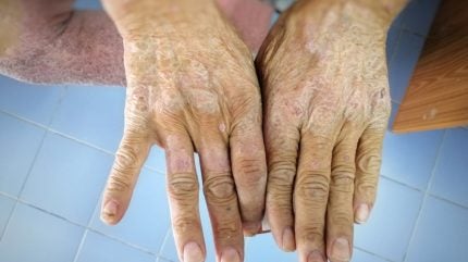 Chemomab touts study confirming CCL24 link to systemic sclerosis severity