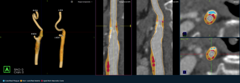 Elucid Launches PlaqueIQ Image Analysis Software for the Carotid Arteries