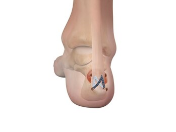 Arthrex Wins Both Gold and Silver Medals at 2024 Edison Awards