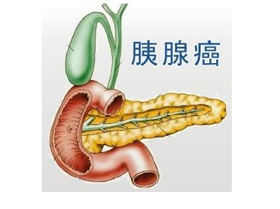 胰腺癌创新疗法！Nant癌症疫苗三线治疗：总生存期达6.3个月，是历史生存数据的2倍！
