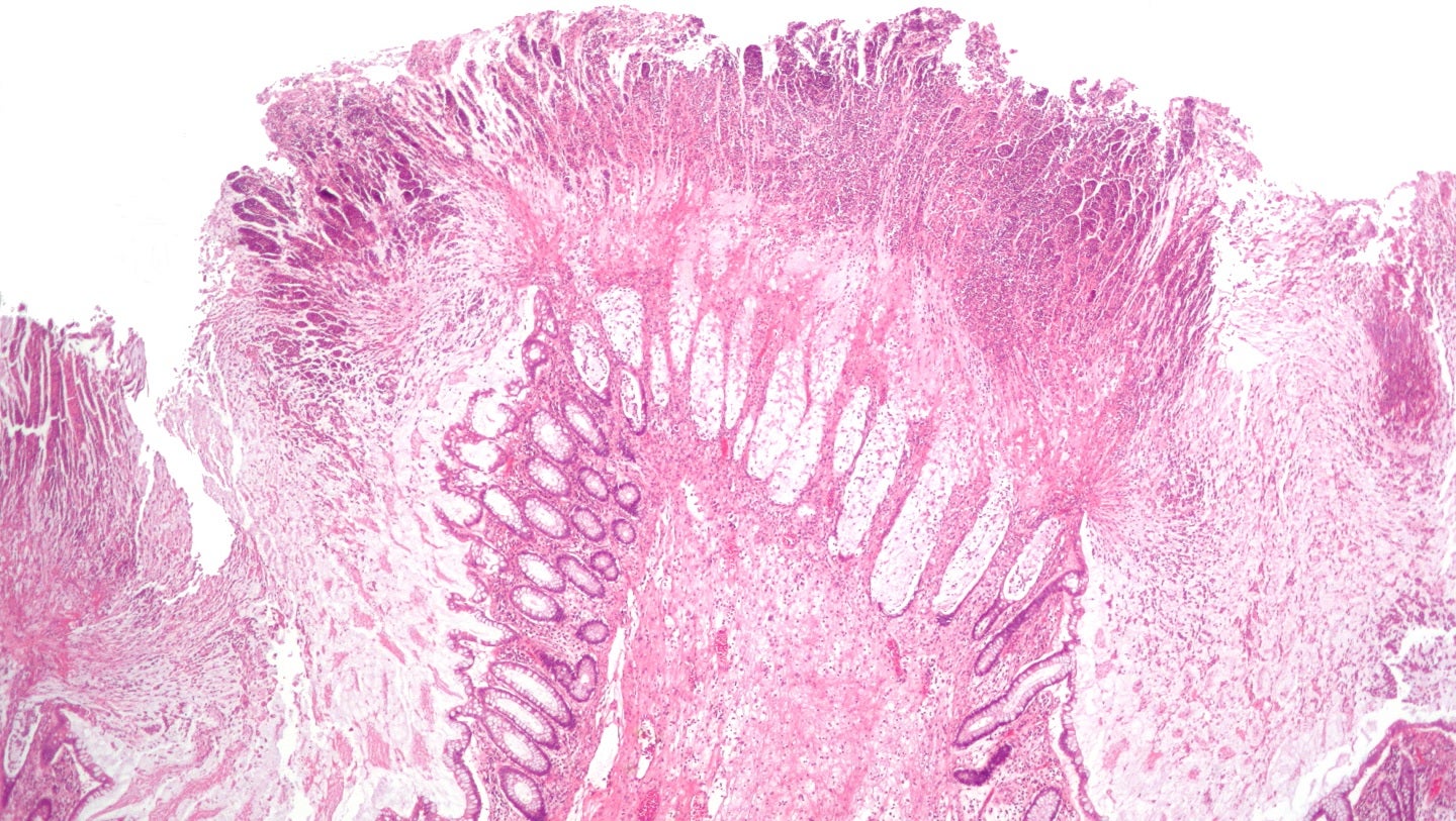 Seres and Nestlé Health receive FDA approval for Vowst microbiome therapy