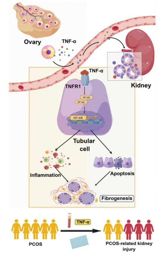 血清肿瘤坏死因子-α在多囊卵巢综合征相关肾损伤的肾小管上皮细胞炎症和凋亡中起关键作用