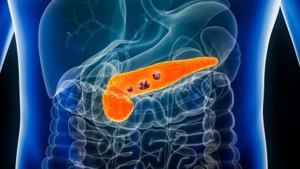 FDA approves Ipsen’s Onivyde for pancreatic adenocarcinoma