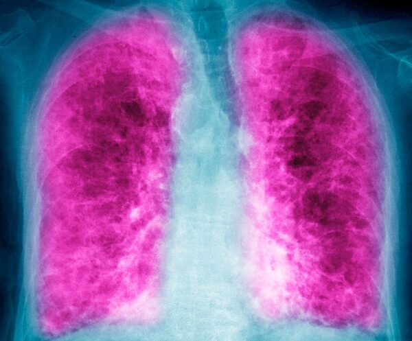 Alentis Therapeutics Lands $105M for Clinical Trials in Fibrosis and Cancer