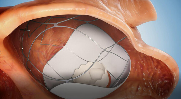 It Might Be the End of Open-Heart Surgeries: Israeli Biomed Company TruLeaf Medical Will Implant a Mitral Heart Valve via Two Needle Sticks only in a Two-Stage Catheterization Without Surgery